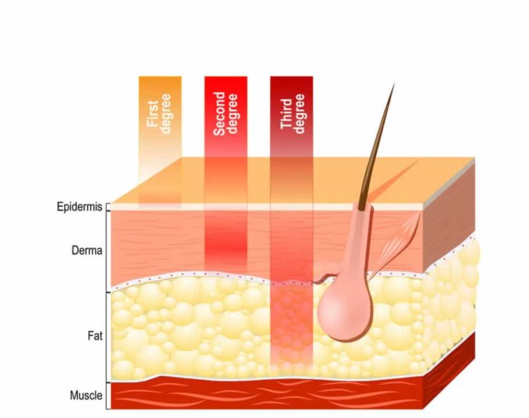 Types of Burn Injuries