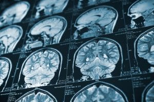 The Effect of Traumatic Brain Injuries on Caregivers