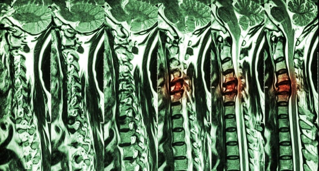 spinal-cord-compression-can-lead-to-paralysis-mcnicholas-mcnicholas